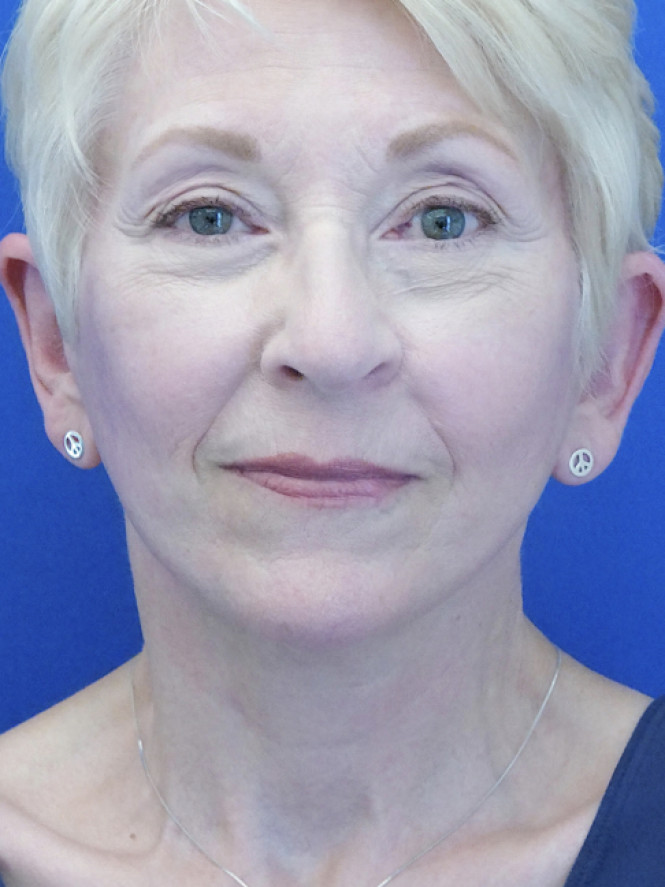 Deep Plane Naturale — After