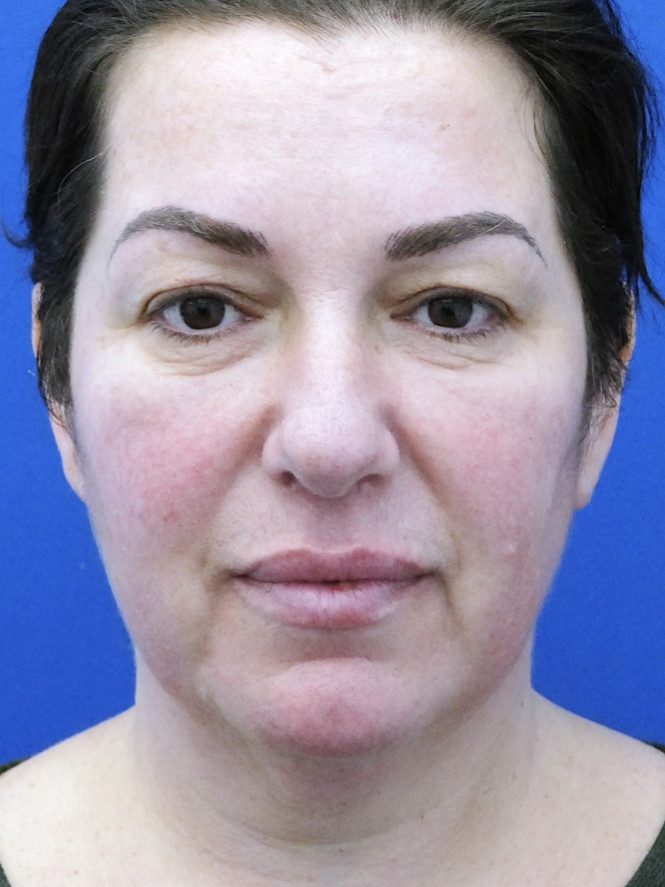 Natural Result — Before