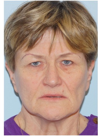 Endoscopic Browlift & Upper Eyelid Droop* — Before