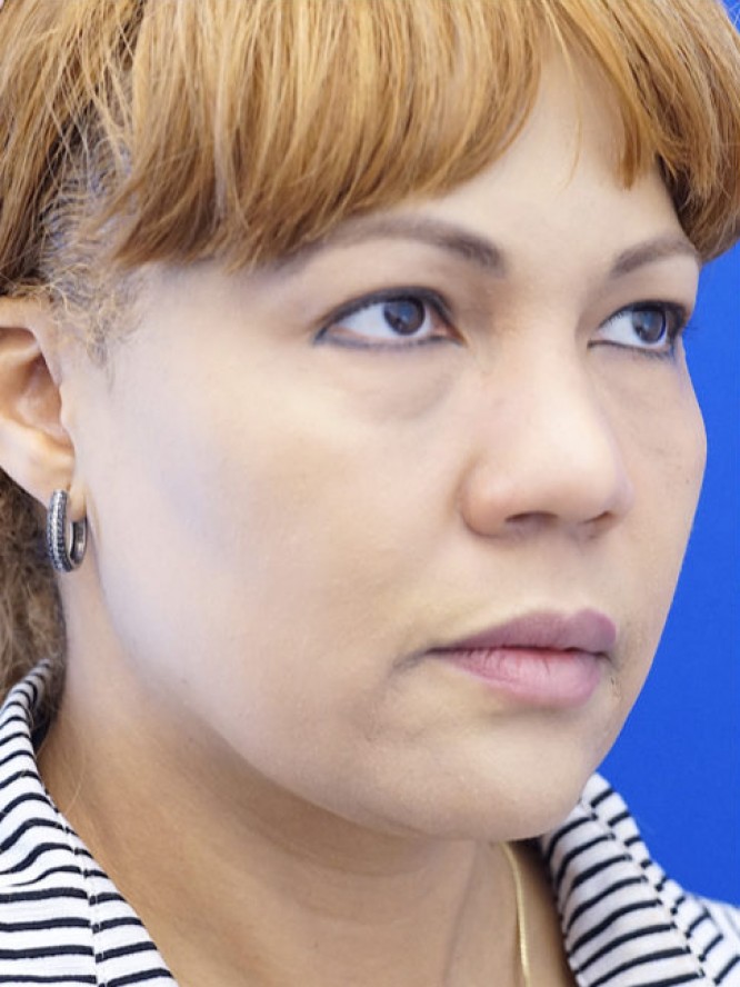 Narrow Widened Nose — Before