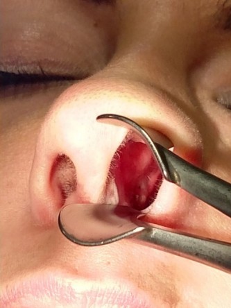 Repair of Nasal Septal Perforation* — After
