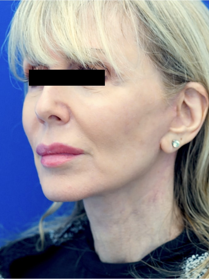 Necklift Lateral Platysma Suspension — After
