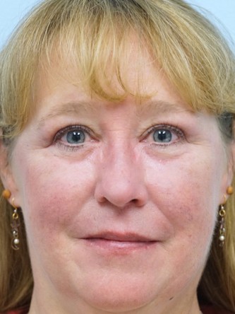 Upper and Lower Eyelid Blepharoplasty* — After