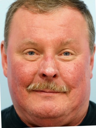 Rhinophyma* — After