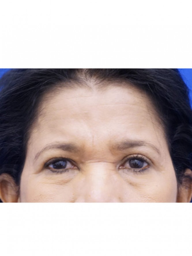 Endoscopic Forehead Lift — Before
