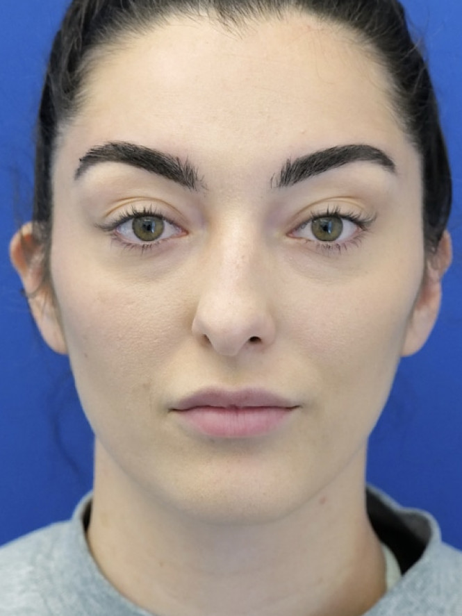 Ideal Nasal Profile — Before