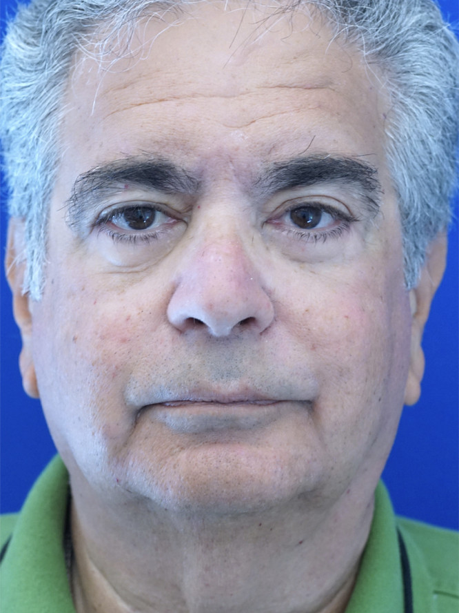 Four Quadrant Blepharoplasty — After