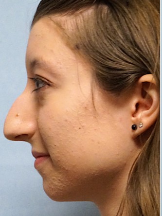 Prominent Nose Closed Rhinoplasty* — Before