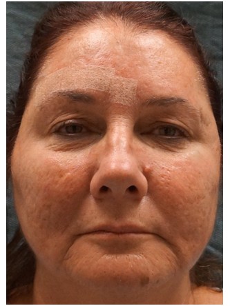 Fractional CO2 Laser Skin Resurfacing3* — Before