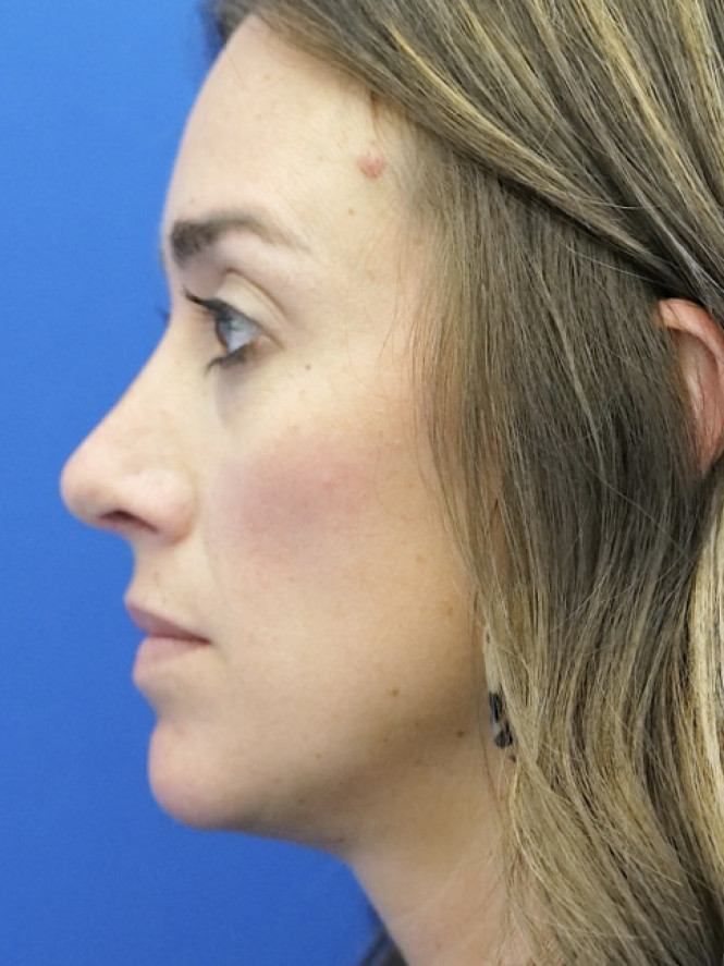Preservation Rhinoplasty — After