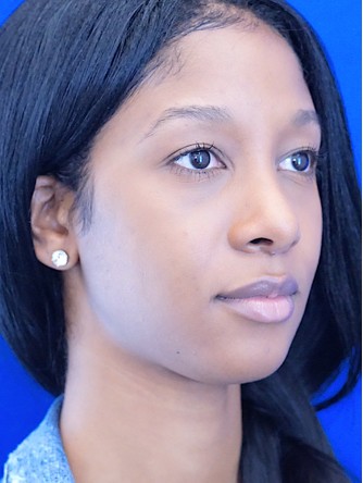 Ethnic Rhinoplasty* — After