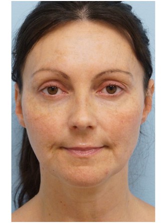 Fractional CO2 Laser Skin Resurfacing2* — Before