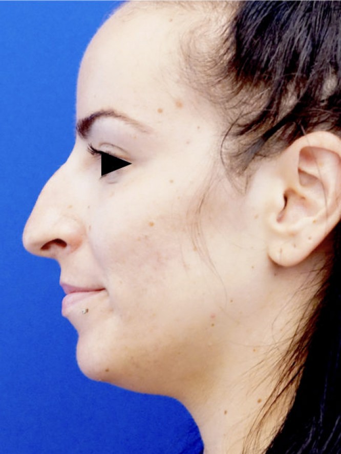Nasal Tip Refinement — Before