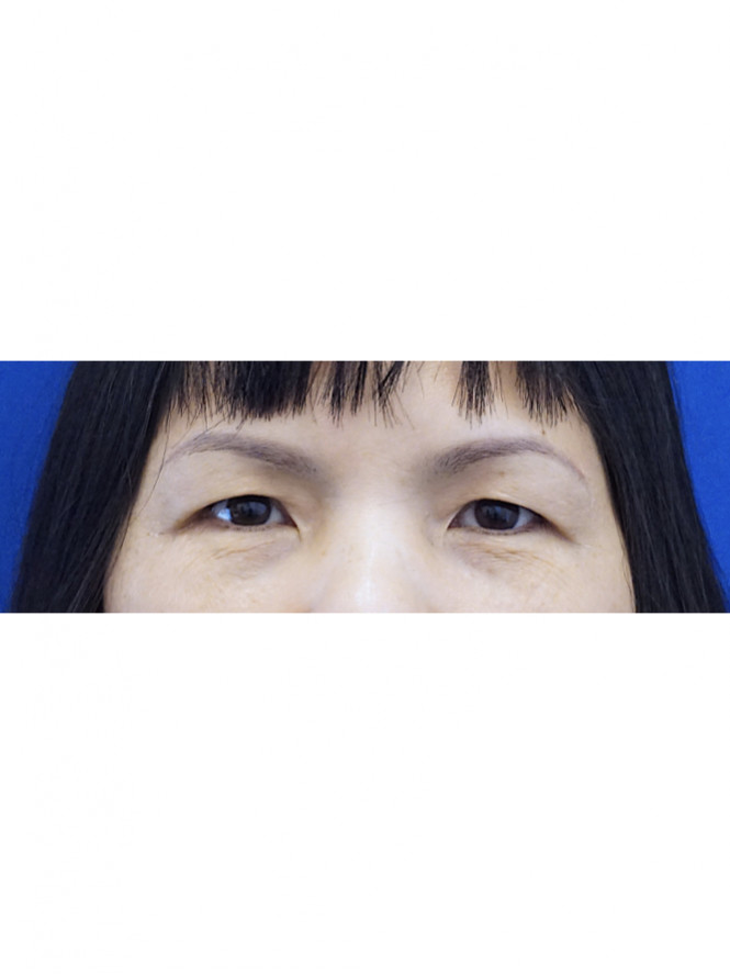 Eyelid Crease Revelation — Before