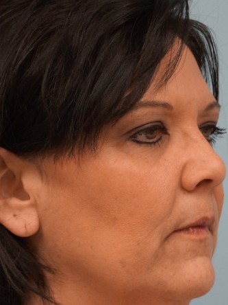 Radiesse to Malar Cheek and Laugh Lines* — Before