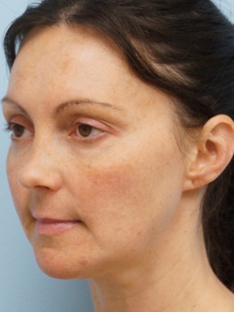 Fractional CO2 Laser Skin Resurfacing2* — Before