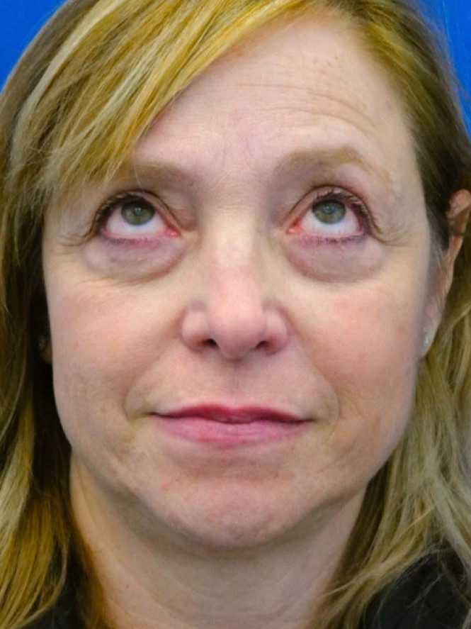 Upper and Lower Blepharoplasty — Before