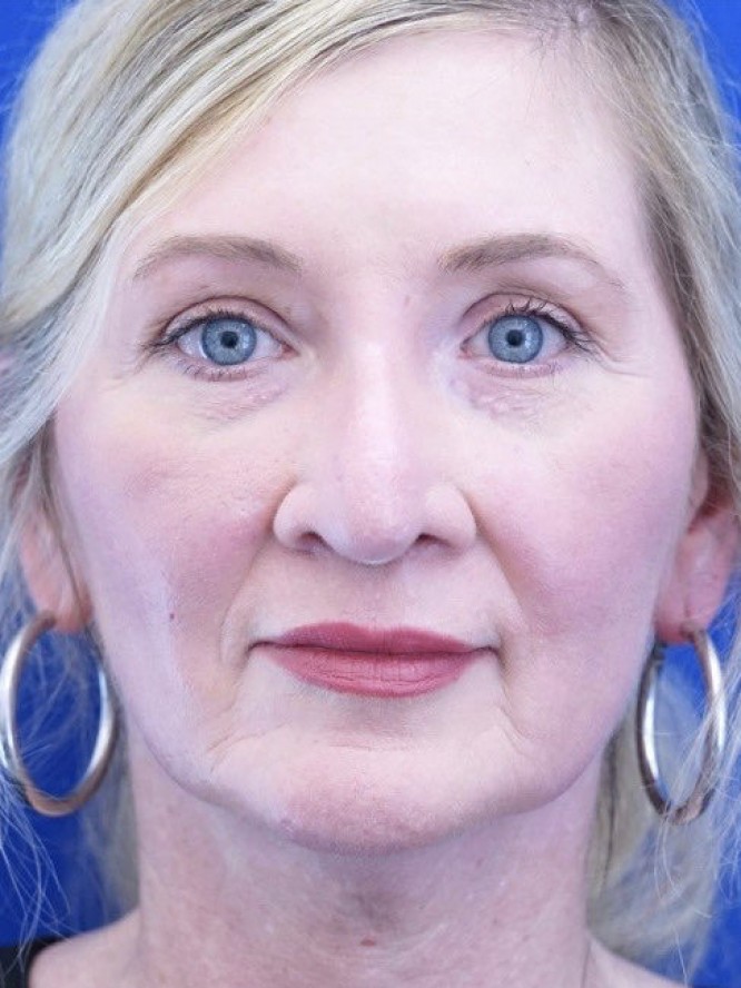 Thick Skin Droopy Nose — Before