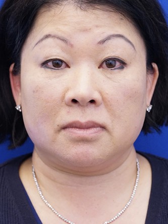 Asian Blepharoplasty — Before