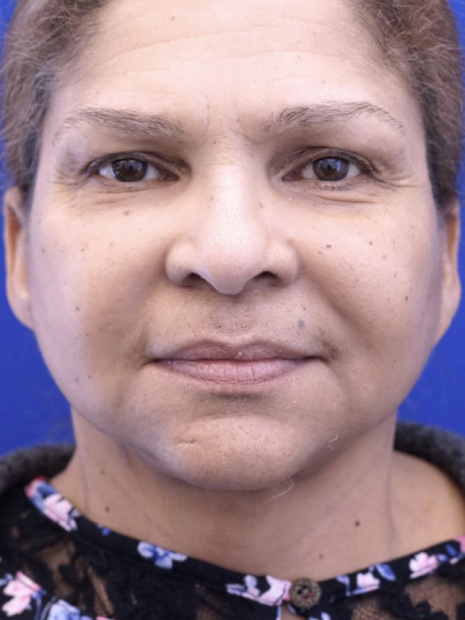 Necklift and Liposuction — After