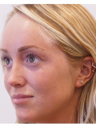 Restylane Silk to Upper & Lower Lips* — Before