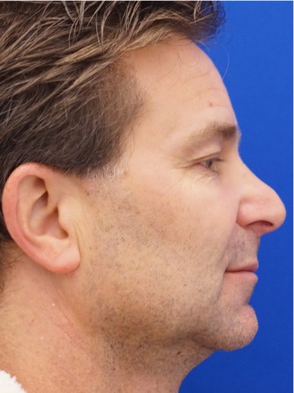 Nasal Tip Droop* — Before