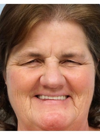 Brow Droop & Upper Eyelid Skin Excess* — Before