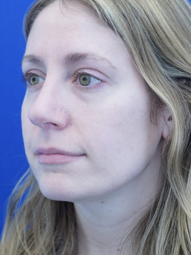 Nasal Profile Finesse — After