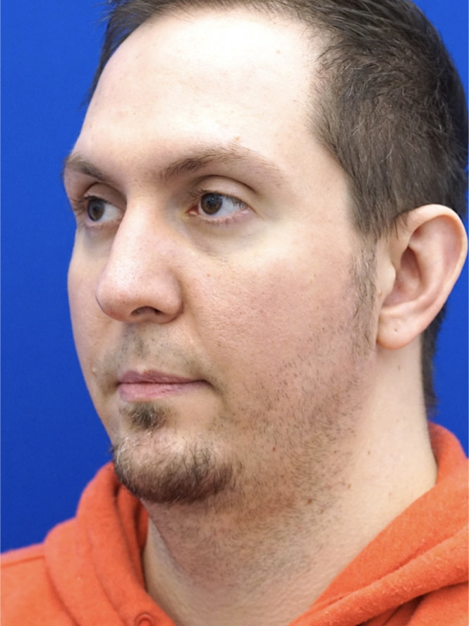 Lower Facial Contouring — Before