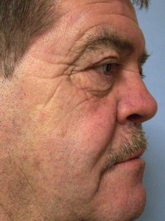 Saddle Nose – Repair Using Ear Cartilage* — After