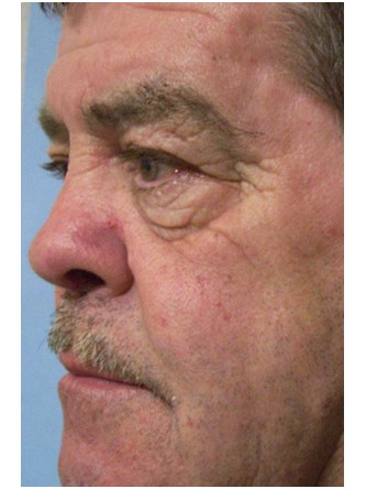 Saddle Nose – Repair Using Ear Cartilage* — After
