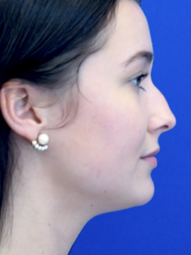 Soften Nasal Bridge — Before