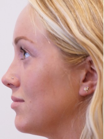 Restylane Silk to Upper & Lower Lips* — Before