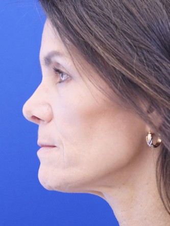 Nasal Tip Deformity — After