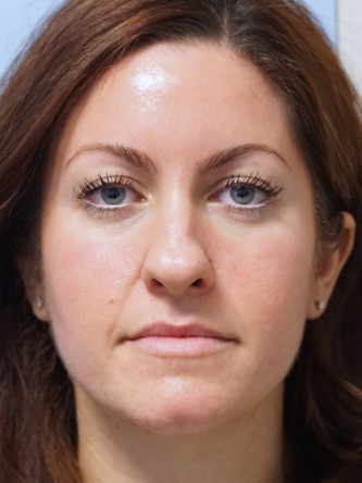 Boxy Tip Endonasal Rhinoplasty* — Before