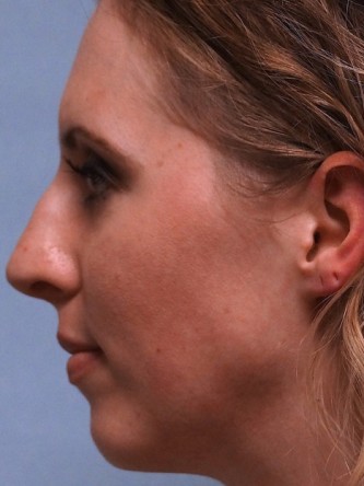 Crooked Nose & Cartilage Deformity1* — Before