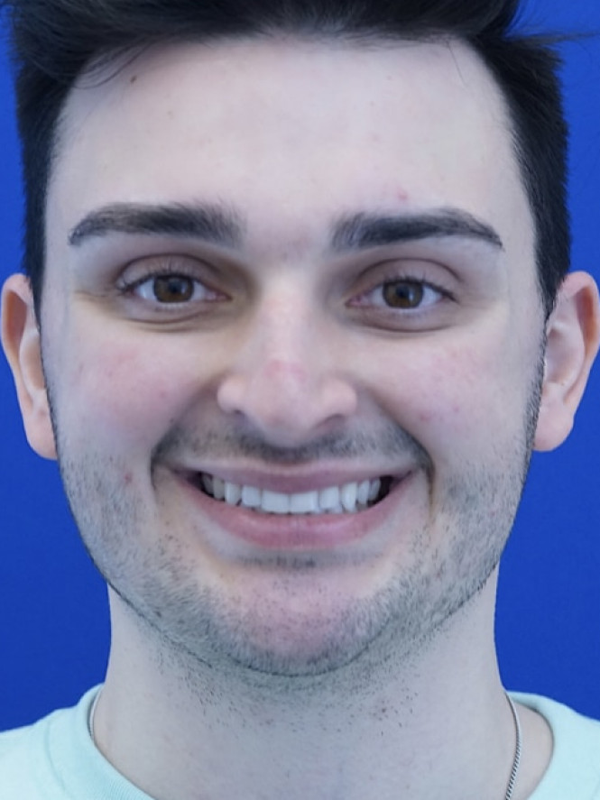 Profile Enhancement — Before