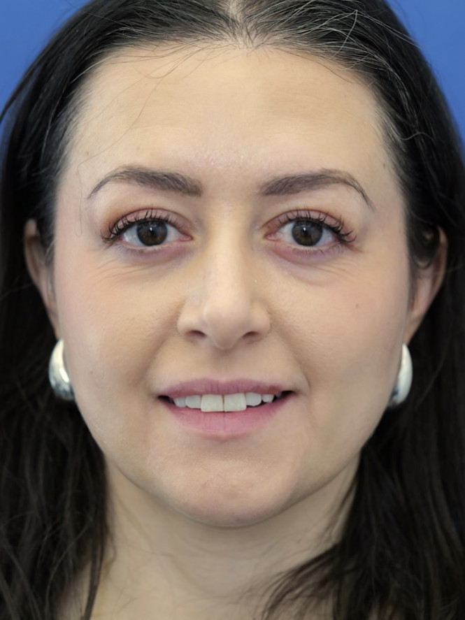 Case 6868: after Brow Fat Suspension
