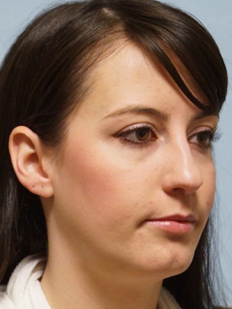 Repair of Nasal Septal Perforation* — Before