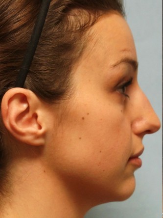 Mild Dorsal Hump* — Before