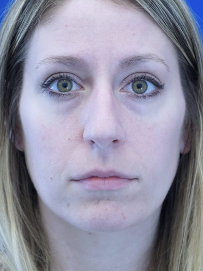 Nasal Profile Finesse — Before