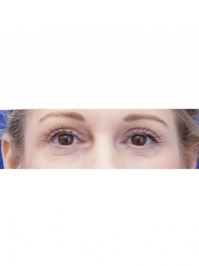 Lower Blepharoplasty and Fat Grafting — Before