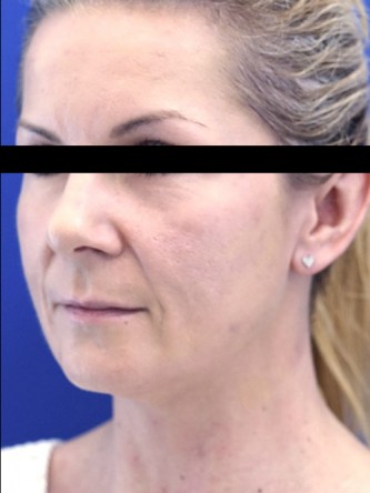 Upper Lip Shortening — Before