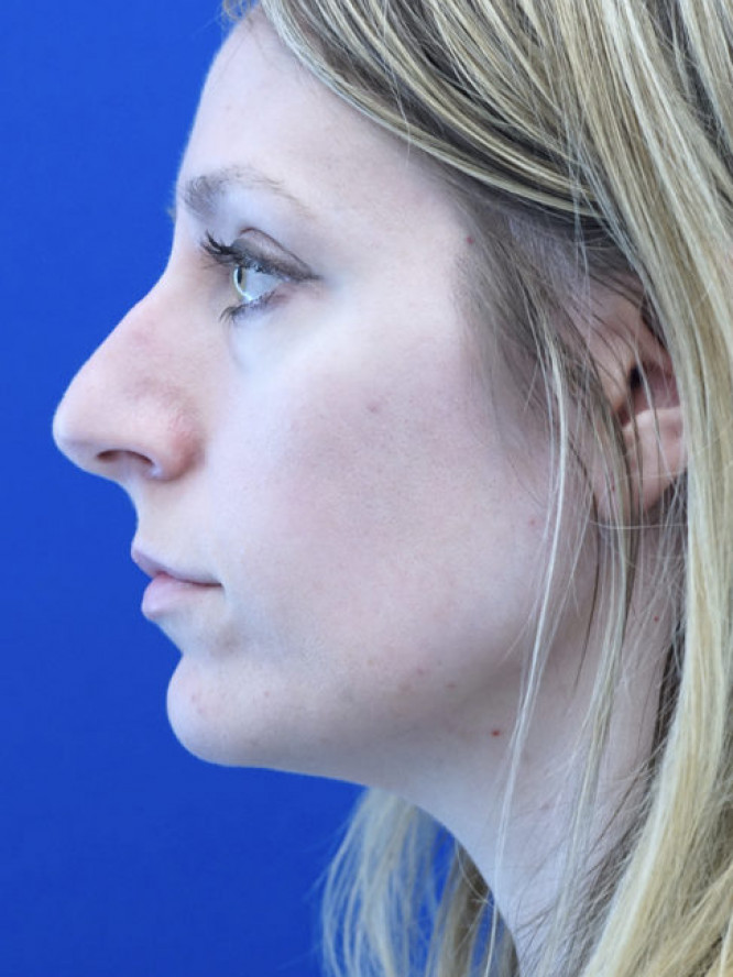 Nasal Profile Finesse — Before