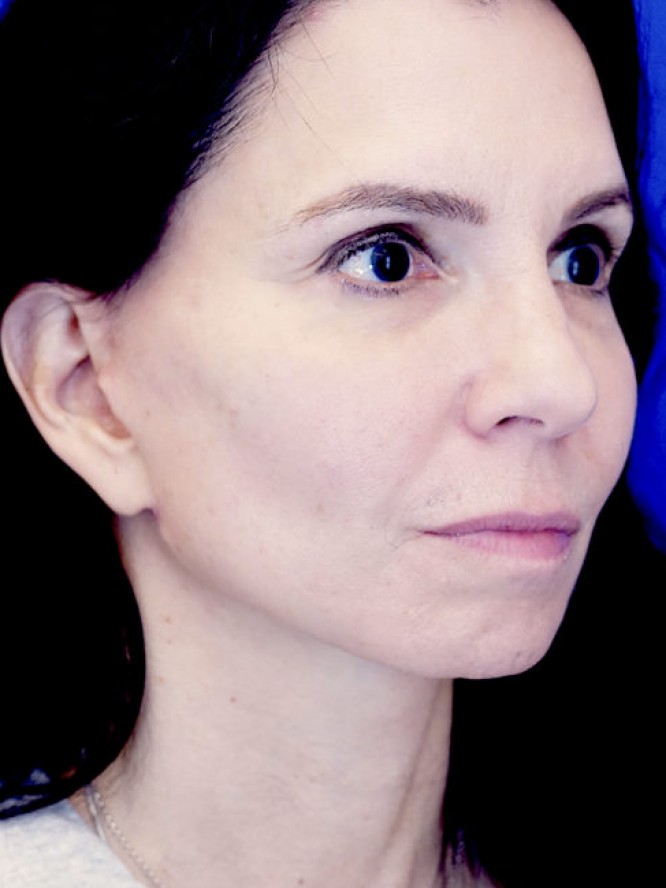 Deep Plane Jowl Lifting — After