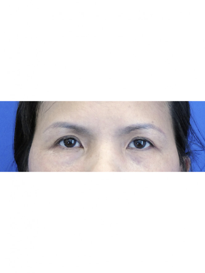 Eyelid Crease Revelation — After