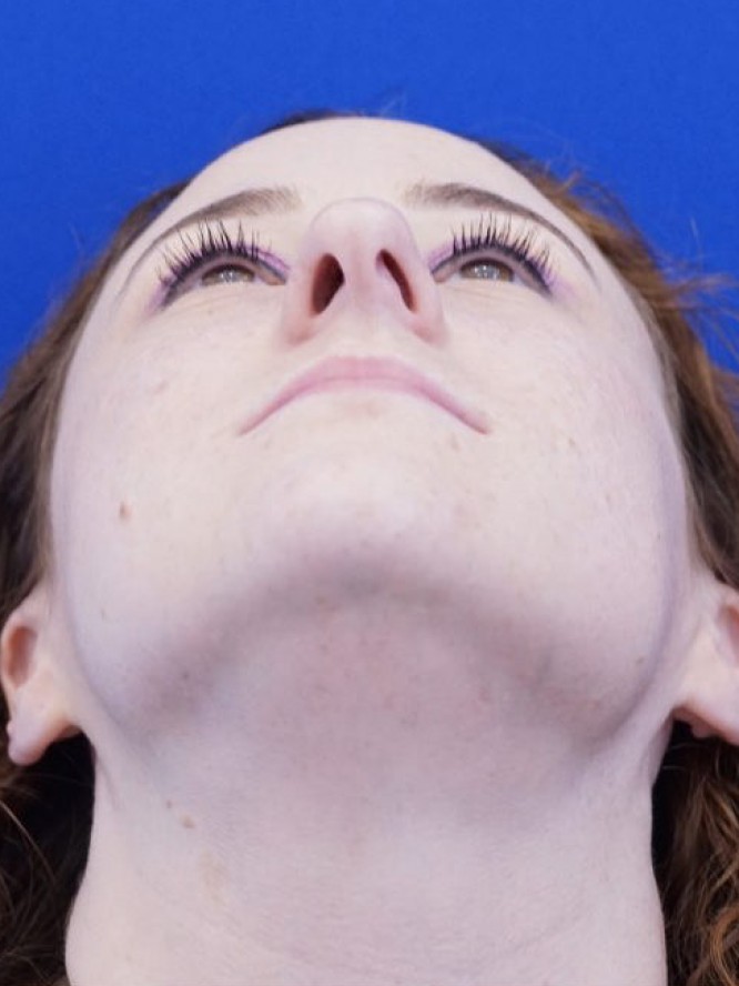 Finesse Nasal Contour — Before