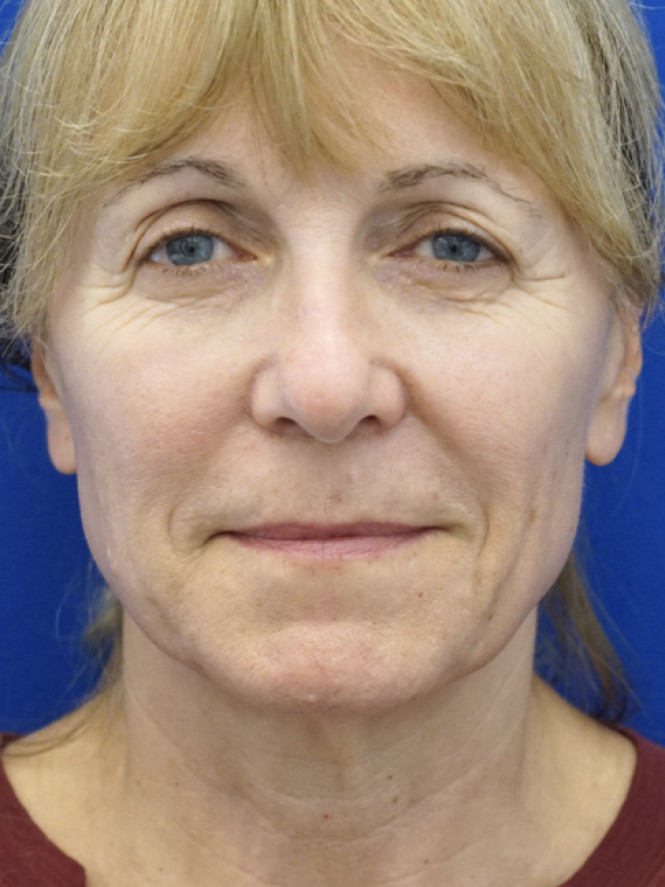 Hairline Browlift — Before