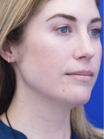 Chin LipoSculpture* — Before