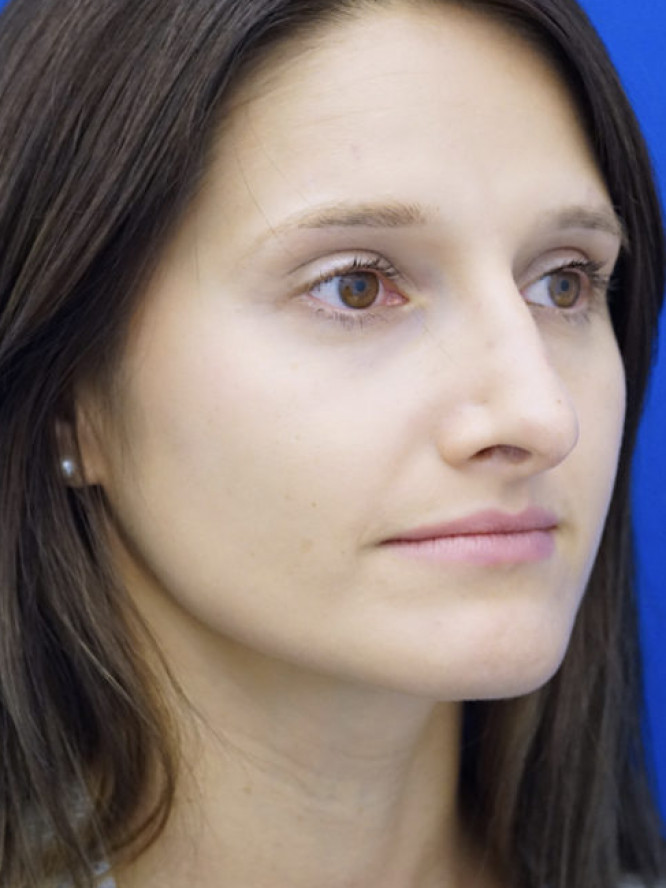 Nasal Profile Bliss — Before